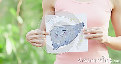 Woman with cirrhosis liver Stock Photo