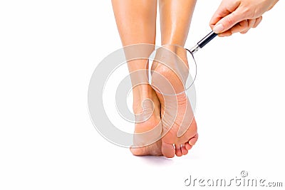 Woman with cracked heels problem Stock Photo