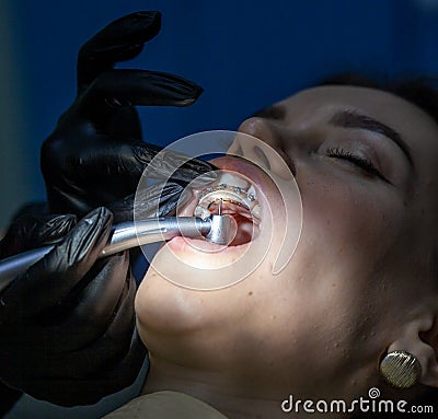 A woman at a dentist& x27;s appointment to replace arches with braces Stock Photo