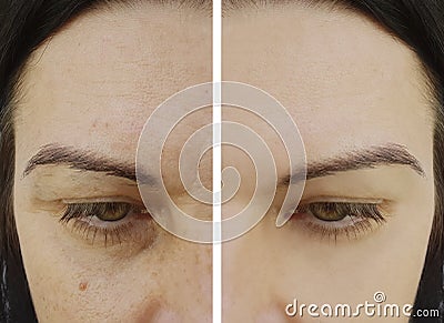 Woman difference wrinkles beautician pigmentation face patient before and after lifting cosmetic procedures Stock Photo