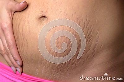 Woman displaying stretch marks after pregnancy Stock Photo