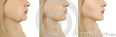 Woman double chin facelift tightening loss sagging before after problem oval liposuction collage procedures Stock Photo