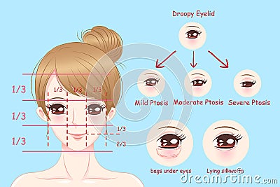 Woman with droopy eyelids Vector Illustration