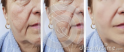 Woman elderly face skin wrinkles correction contrast before and after procedures, arrow Stock Photo