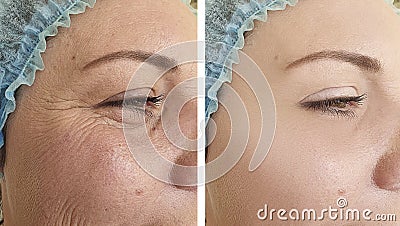 Woman elderlyface wrinkles correction before after lifting biorevitalization regeneration antiaging treatment Stock Photo