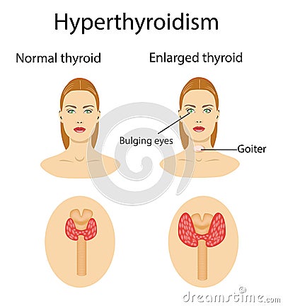 Woman with enlarged hyperthyroid gland. Vector illustration. Vector Illustration