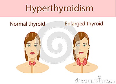 Woman with enlarged hyperthyroid gland. Vector illustration. Vector Illustration