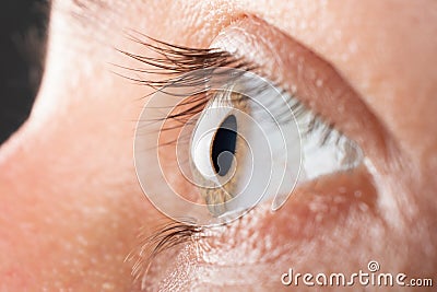 Woman eye closeup with 3 stage of keratoconus, corneal dystrophy Stock Photo