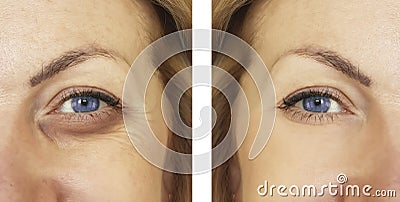 Woman, eye swollen before and after procedures, treatm Stock Photo