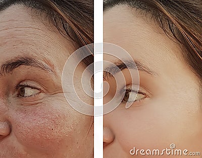 Woman eye wrinkles before and after dermatology cosmetic procedures Stock Photo