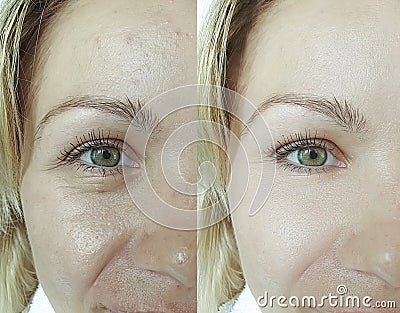Woman eyes removal wrinkles before and after therapy antiaging difference results revitalization treatment Stock Photo