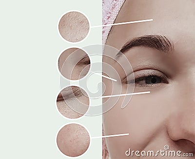 Woman eyes wrinkles bloating dermatology therapy concept contrast before and after collage Stock Photo