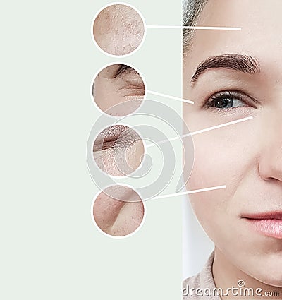 Woman eyes wrinkles bloating contrast before and after procedures collage Stock Photo