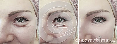 Woman face crease arrow difference effect eye removal before and after treatment Stock Photo