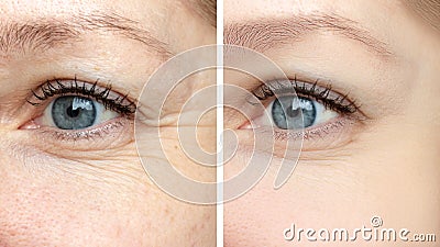 Woman face, eye wrinkles before and after treatment - the result of rejuvenating cosmetological procedures of biorevitalization, Stock Photo