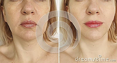 Woman face lift before and after treatment plastic Stock Photo