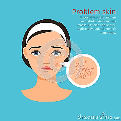 Woman face problem, buried capillaries skin Vector Illustration