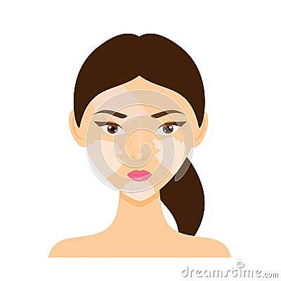 Woman face with vitiligo skin disease Vector Illustration
