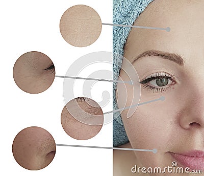 Woman face wrinkles before and after collage saggy treatment Stock Photo