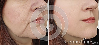 Woman face wrinkles face lifting before and after difference treatment Stock Photo