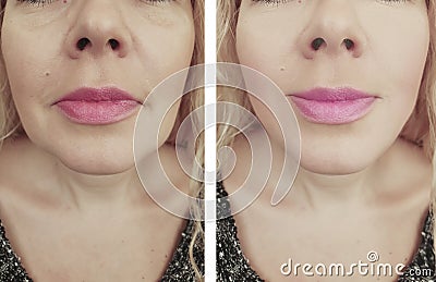 Woman face wrinkles before and after lifting biorevitalization regeneration antiaging cosmetology treatment Stock Photo