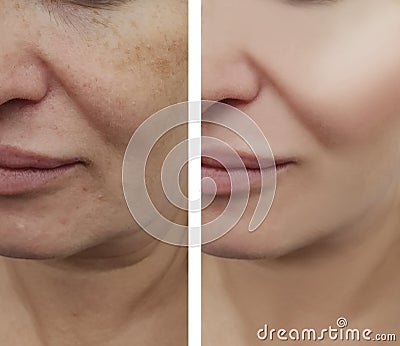 Woman face wrinkles pigmentation removal correction treatment health before and after procedures Stock Photo