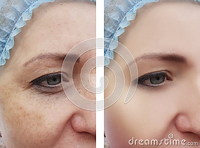 Woman face wrinkles pigmentation removal health before and after procedures Stock Photo