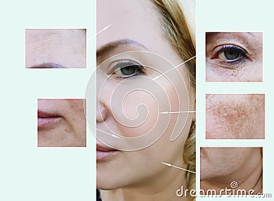 Woman face wrinkles before and after aging procedures, pigmentation dermatology Stock Photo