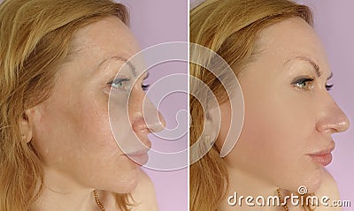 Woman face wrinkles before cosmetology saggy difference after treatment correction Stock Photo