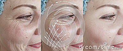 Woman face wrinkles after effect therapy saggy tension plastic difference correction rejuvenation treatment, arrow Stock Photo