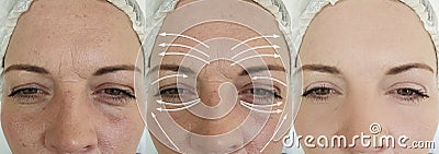 Woman face wrinkles after effect saggy tension plastic difference correction rejuvenation treatment, arrow Stock Photo