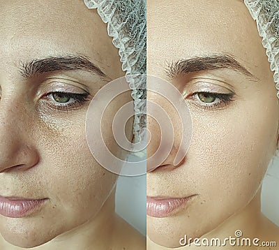 Woman wrinkles regeneration filler cosmetology procedure tightening removal treatment collage Stock Photo