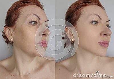 Woman face wrinkles saggy mature care before and after aging hydrating treatment Stock Photo