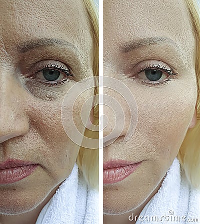 Woman face wrinkles regeneration differencecosmetology before and after treatment Stock Photo