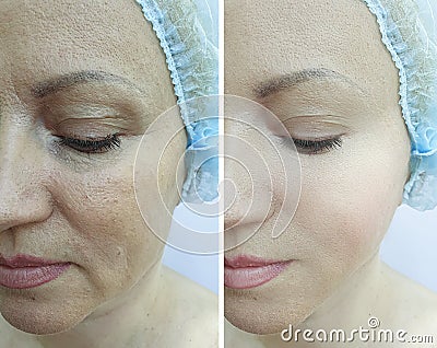 Woman face wrinkles regeneration mature differencecosmetology before and after treatment Stock Photo