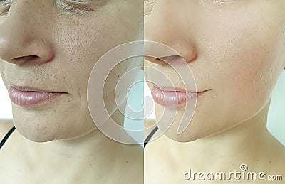 Woman face wrinkles antiaging saggy rejuvenation medicine lifting before and after treatment Stock Photo