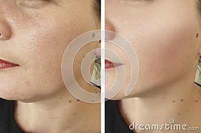 Woman face wrinkles lifting correction before after antiaging revitalization treatments Stock Photo