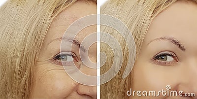 Woman face wrinkles before and after Stock Photo