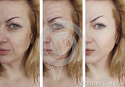 Woman facial wrinkles skin correction effect cosmetology aging before and after procedures arrow Stock Photo