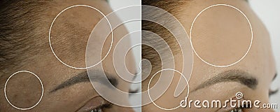 Woman forehead pigmentation before and after treatment Stock Photo