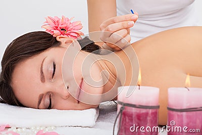 Woman getting acupuncture therapy Stock Photo