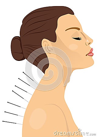 Woman getting an acupuncture treatment Vector Illustration