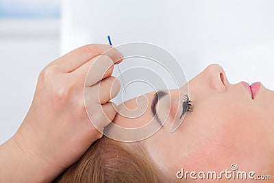 Woman getting acupuncture treatment Stock Photo