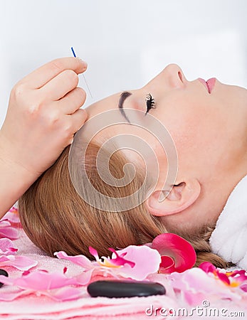 Woman Getting Acupuncture Treatment Stock Photo