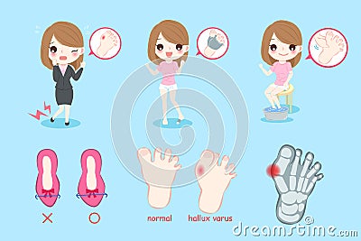 Woman with hallux varus Stock Photo