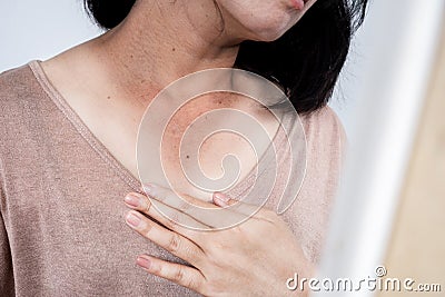 woman have problem with sun exposure, sunburn on neck, checking her dark spot and damaged skin in from of a mirror Stock Photo