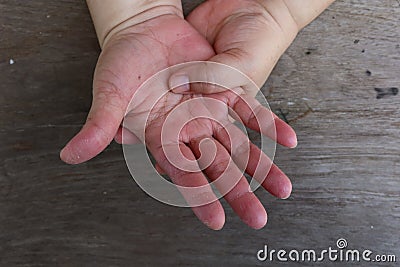 Woman holding her wrist and fingers feeling pain, suffering and numbness. Concept of Guillain barre syndrome and hand numbness aft Stock Photo