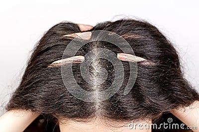 The woman holds her head with her hands, showing a parting of dark hair with dandruff. Close up. The view from the top. White Stock Photo