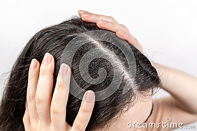 The woman holds her head with her hands, showing a parting of dark hair with dandruff. Close up. The view from the top. Zoomed Stock Photo