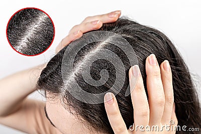 The woman holds her head with her hands, showing a parting of dark hair with dandruff. Close up. The view from the top. Zoomed Stock Photo